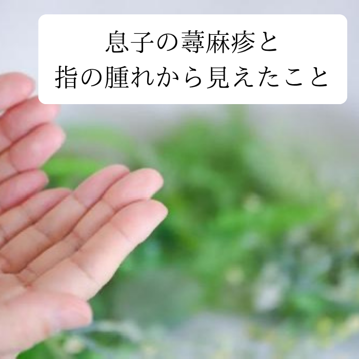息子の蕁麻疹と指の腫れから見えたこと